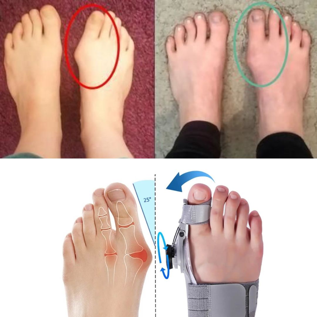 Correcteur d'Hallux Valgus Efficace - Soulagement Douleur